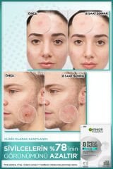 Pimple Patch 22'li Sivilce Bandı / Hidrokolloid Bant / Akne Karşıtı 22li Bant